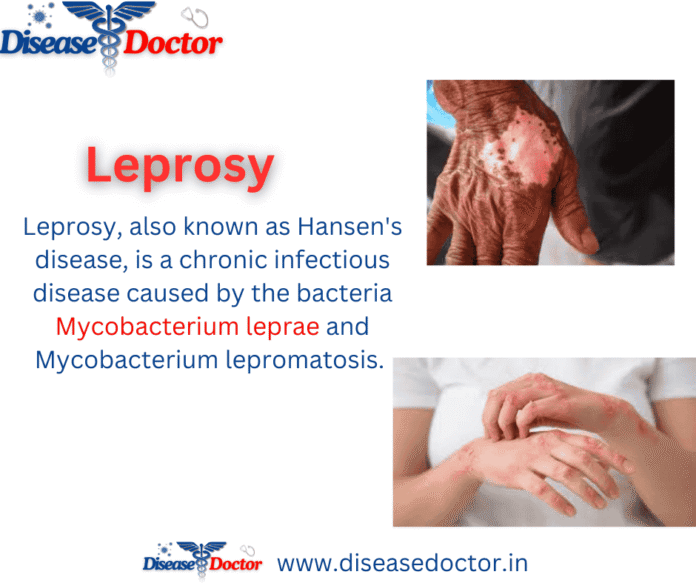 Leprosy